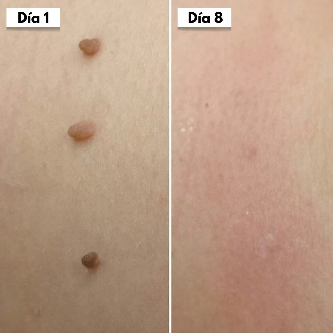 DermaSkin Pro™ - Dile adiós a las imperfecciones de la piel