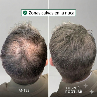 Sistema de crecimiento capilar Apex