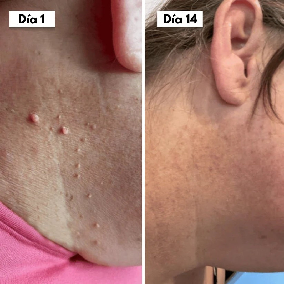 DermaSkin Pro™ - Dile adiós a las imperfecciones de la piel