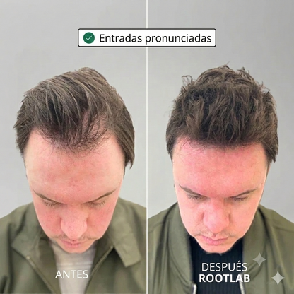 Sistema de crecimiento capilar Apex