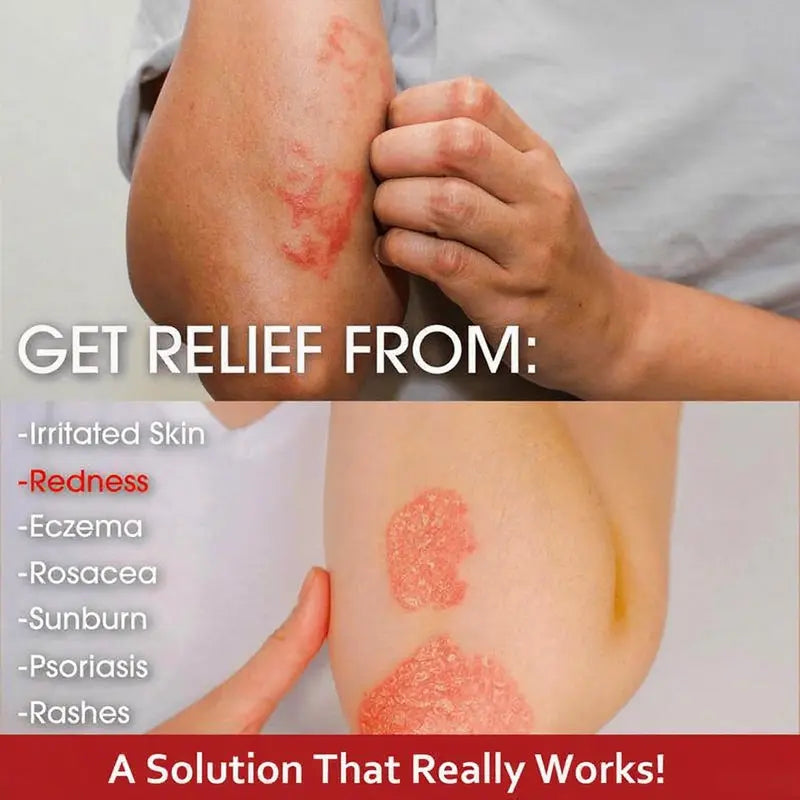 Crema de alivio herbal totalmente natural Umex a base de plantas: alivia el eccema, la psoriasis y la piel seca y sensible | Fórmula botánica ancestral para una hidratación diaria para toda la familia.