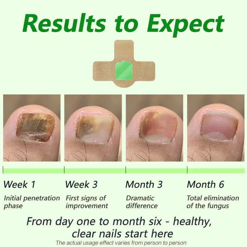 Parches para hongos en las uñas Lansiyi, 21 unidades/caja, para el cuidado de las uñas, con 5 hierbas para tratar hongos y otros problemas, suministros para uñas, kit de cuidado diario, suministros para manicura,