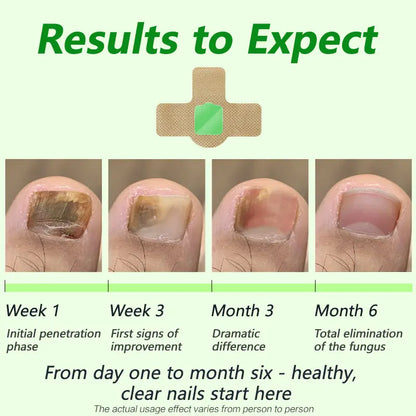 Parches para hongos en las uñas Lansiyi, 21 unidades/caja, para el cuidado de las uñas, con 5 hierbas para tratar hongos y otros problemas, suministros para uñas, kit de cuidado diario, suministros para manicura,