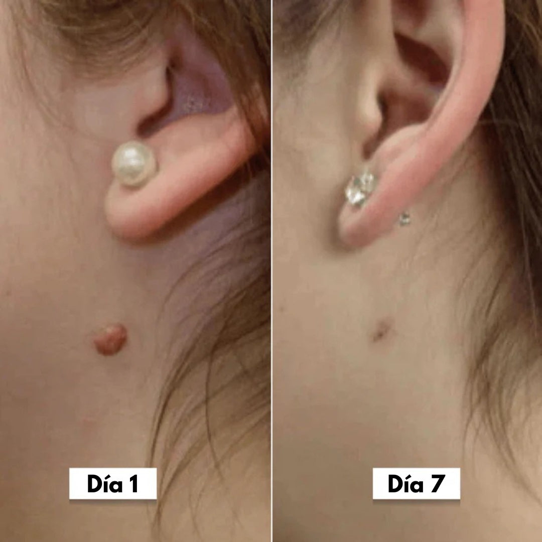 DermaSkin Pro™ - Dile adiós a las imperfecciones de la piel