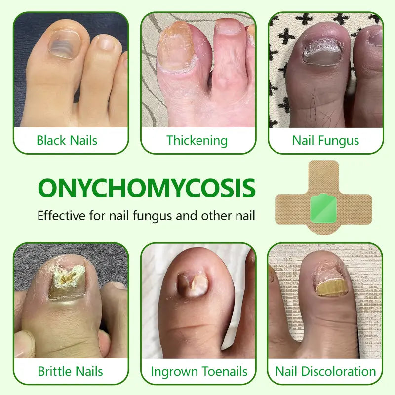 Parches para hongos en las uñas Lansiyi, 21 unidades/caja, para el cuidado de las uñas, con 5 hierbas para tratar hongos y otros problemas, suministros para uñas, kit de cuidado diario, suministros para manicura,