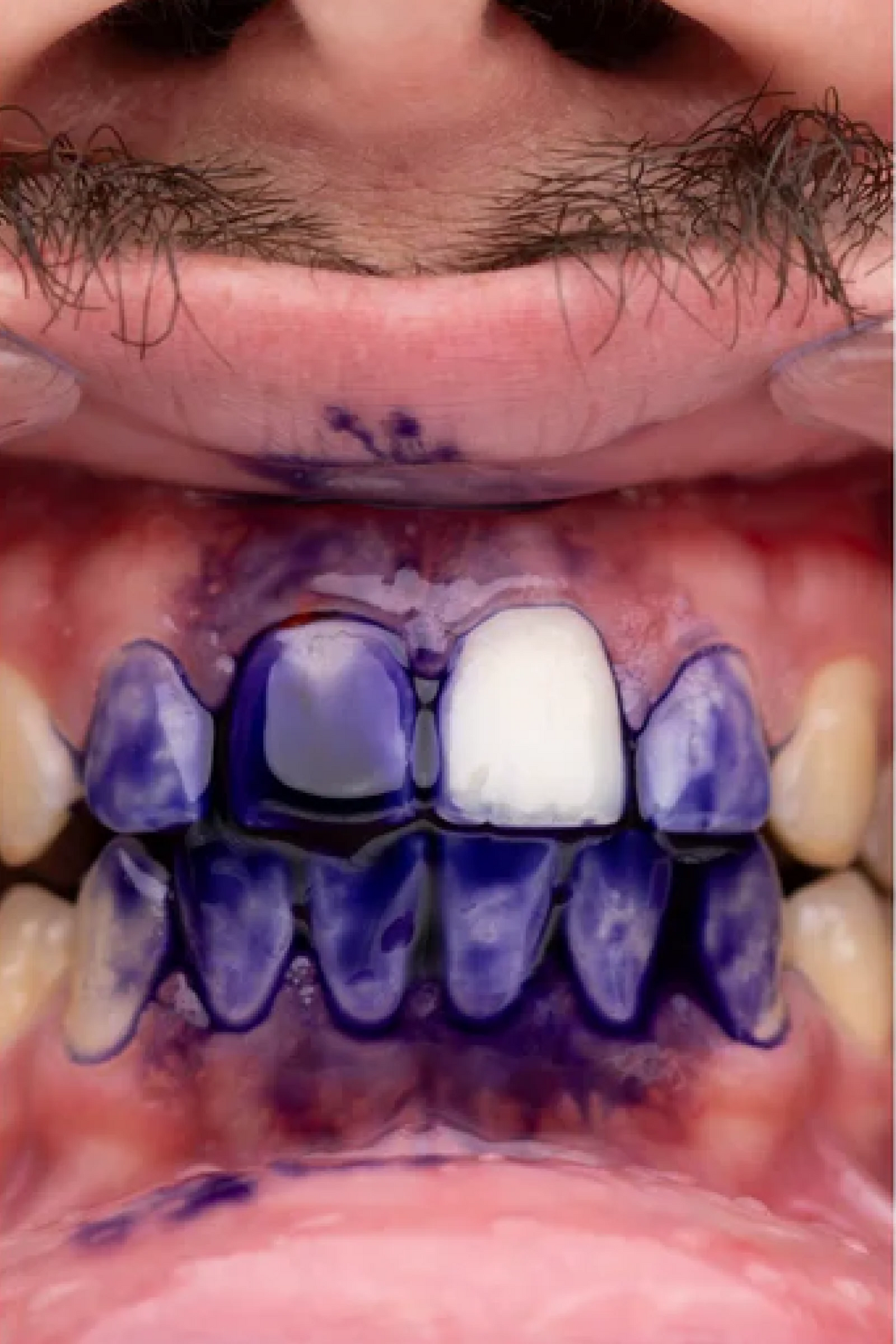 PURPLE V34 - Blanqueamiento Dental