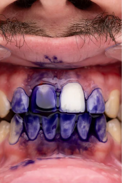PURPLE V34 - Blanqueamiento Dental