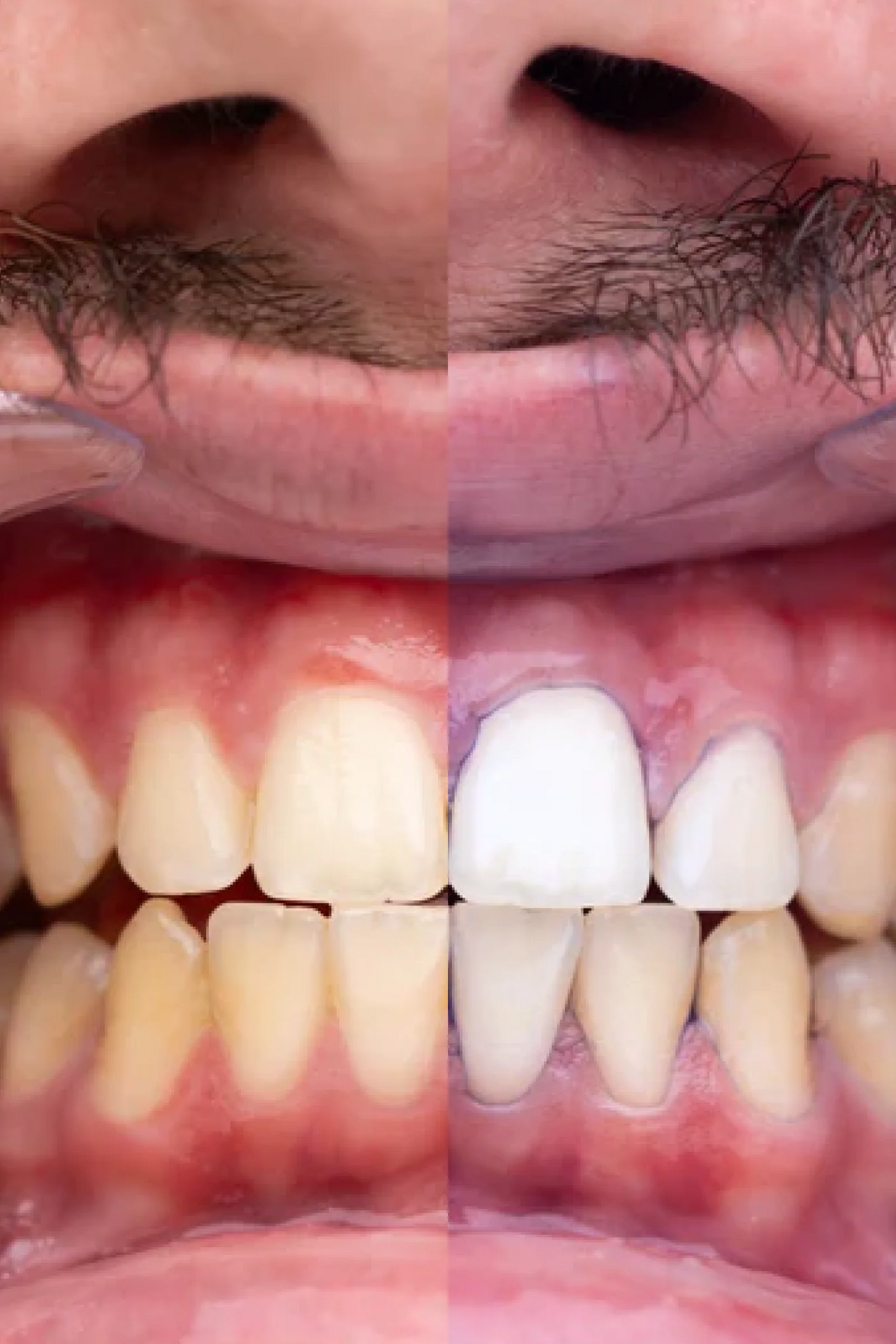 PURPLE V34 - Blanqueamiento Dental