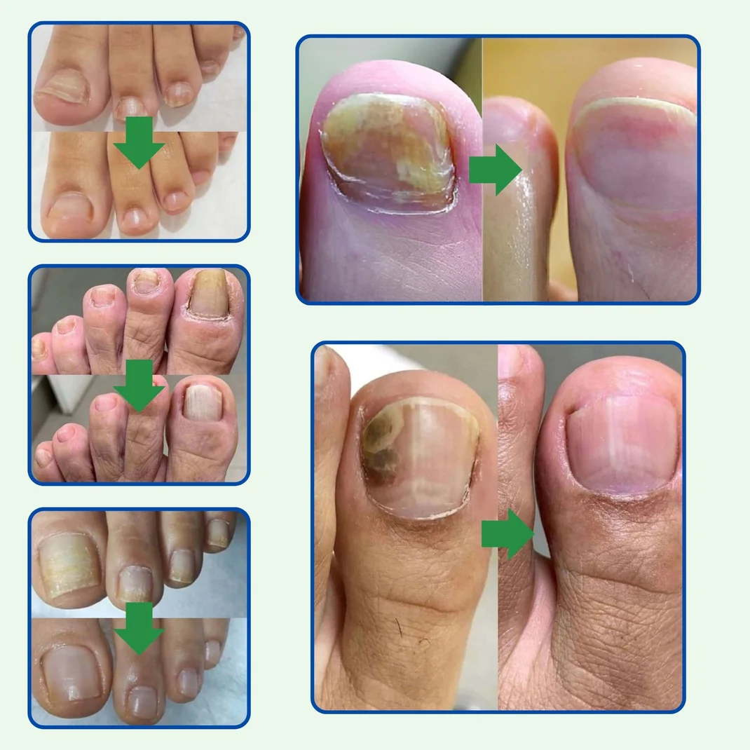 TRATAMIENTO ANTI HONGOS 100% NATURAL 7 DÍAS (2x1)